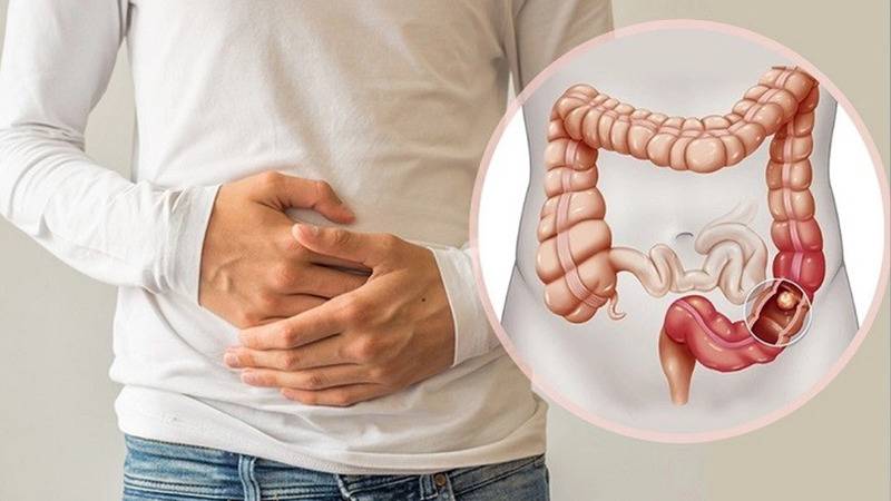 5 Lifestyle Changes to Reduce the Risk of Colon Cancer