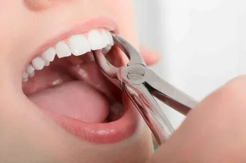 Private dental charges tooth extraction
